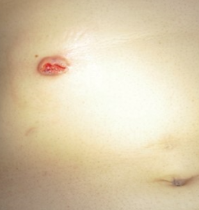 CUTANEOUS METASTASIS AFTER RF APPLICATION FOR LIVER METASTASES