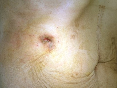 CUTANEOUS METASTASIS - GASTRIC CARCINOMA