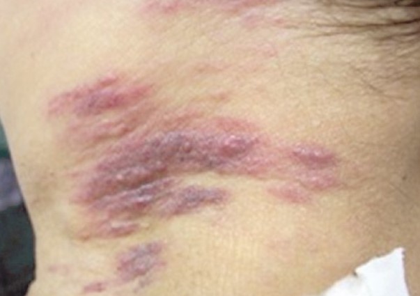 CUTANEOUS METASTASIS - PANCREATIC CARCINOMA 