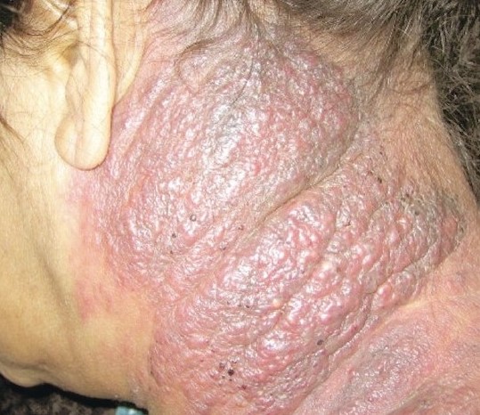 CUTANEOUS METASTASIS - PANCREATIC CARCINOMA