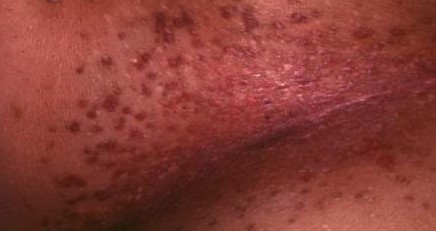 DARIER'S DISEASE