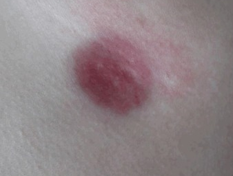 DERMATOFIBROSARCOMA PROTUBERANS