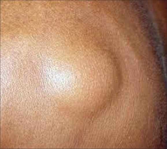 DERMATOFIBROSARCOMA PROTUBERANS