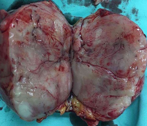 DERMATOFIBROSARCOMA PROTUBERANS