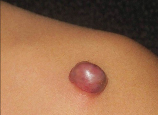 DERMATOFIBROSARCOMA PROTUBERANS