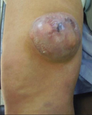 DERMATOFIBROSARCOMA PROTUBERANS