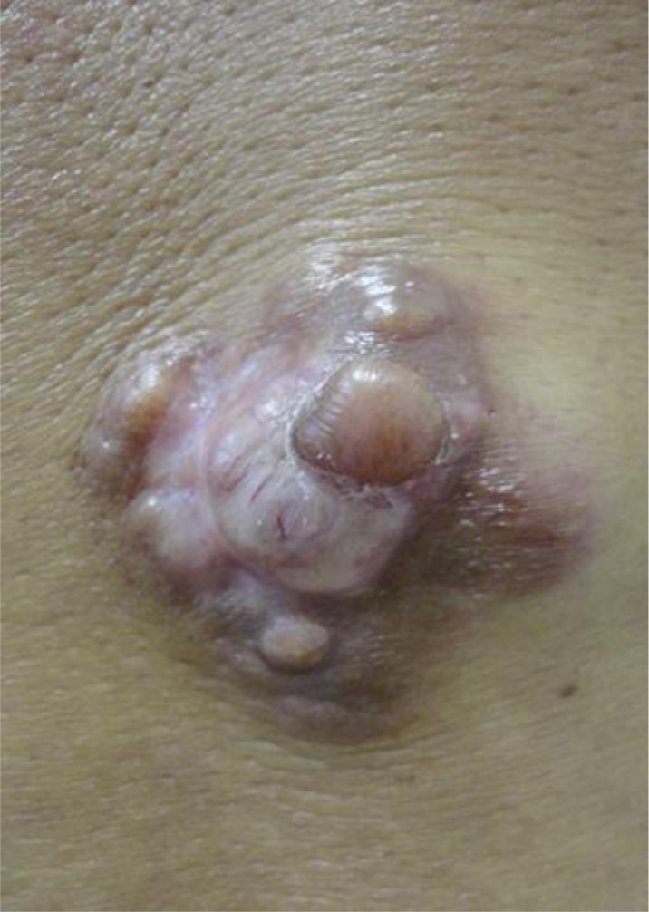 DERMATOFIBROSARCOMA PROTUBERANS