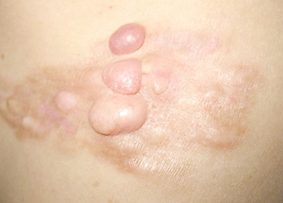 DERMATOFIBROSARCOMA PROTUBERANS