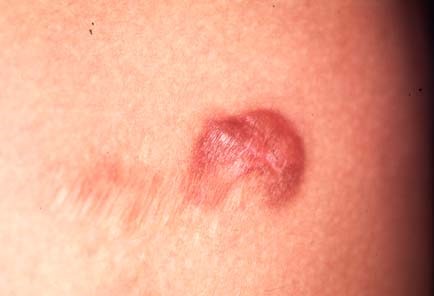DERMATOFIBROSARCOMA PROTUBERANS
