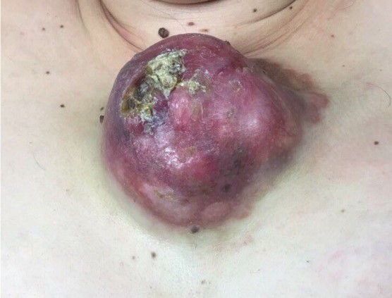 DERMATOFIBROSARCOMA PROTUBERANS
