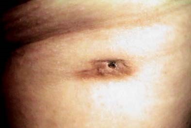 DERMATOFIBROSARCOMA PROTUBERANS