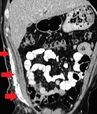 DERMATOMYOSITIS - CALCIFICATIONΣ