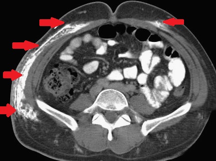 DERMATOMYOSITIS - CALCIFICATIONΣ