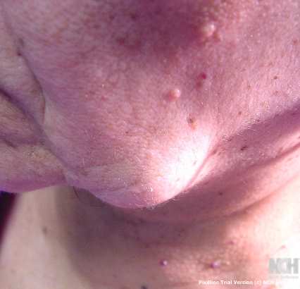 DERMOID CYST
