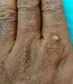 DIGITAL FIBROKERATOMA