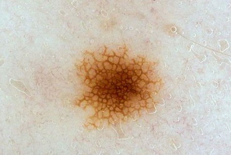 RETICULAR NEVUS