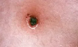 DIPHTHERIA CUTIS