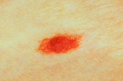 DYSPLASTIC NEVUS