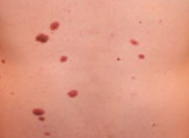 DYSPLASTIC NEVI