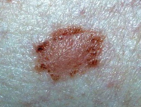 ELLIPTICAL NEVUS