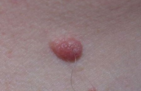 INTRADERMAL NEVUS