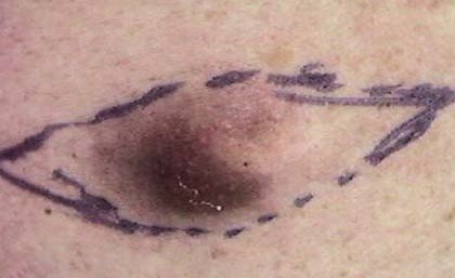 EPIDERMAL CYST