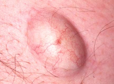 EPIDERMAL CYST 