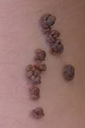 EPIDERMAL NEVI