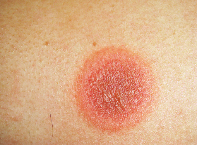 ERYTHEMA ANNULARE