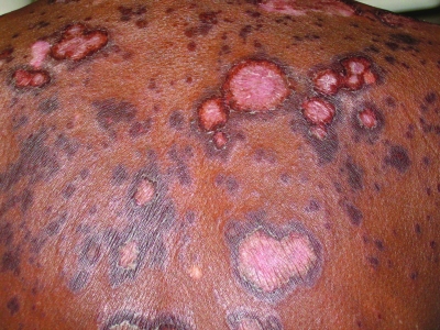 ERYTHEMA GYRATUM REPENS