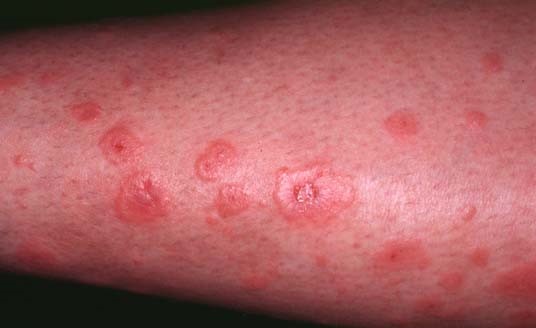 ERYTHEMA MULTIFORME