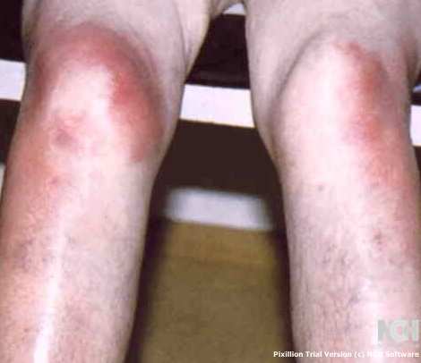 ERYTHEMA NODOSUM - CROHN'S DISEASE