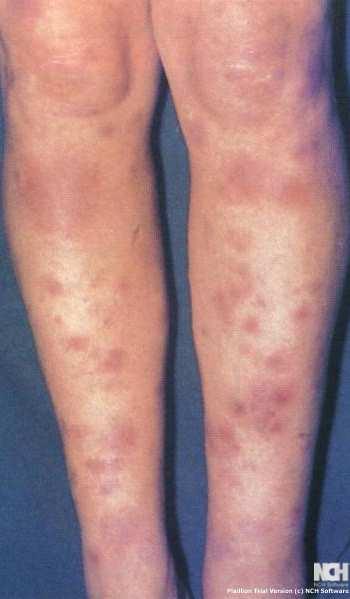 ERYTHEMA NODOSUM - CROHN'S DISEASE