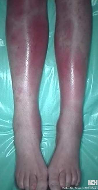 ERYTHEMA NODOSUM - CROHN'S DISEASE