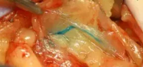 FINDING THE LYMPH CHANNEL