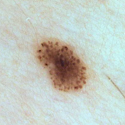 GLOBULAR NAEVUS
