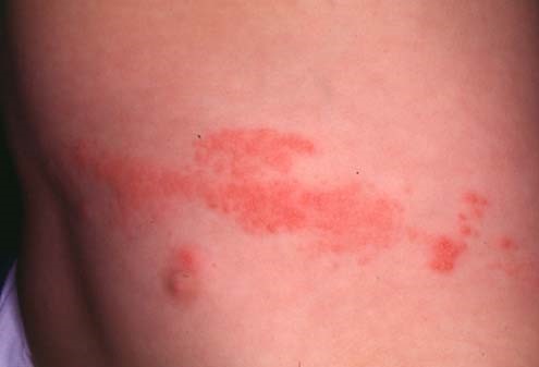 HERPES ZOSTER