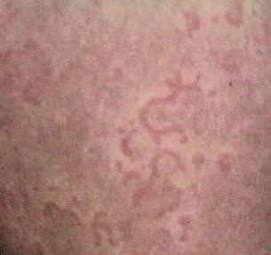 HIVES