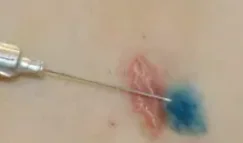 INJECTING THE BLUE DYE AROUND THE MELANOMA