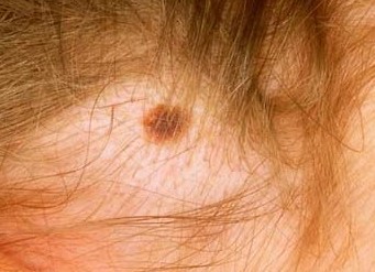INTRADERMAL NEVUS