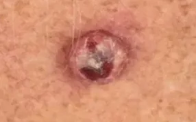 KERATOACANTHOMA