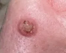 KERATOACANTHOMA 