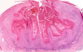 KERATOACANTHOMA 