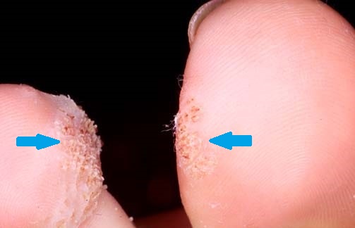 KISSING FINGERS WARTS