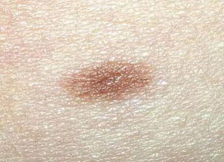 COMMON NEVUS