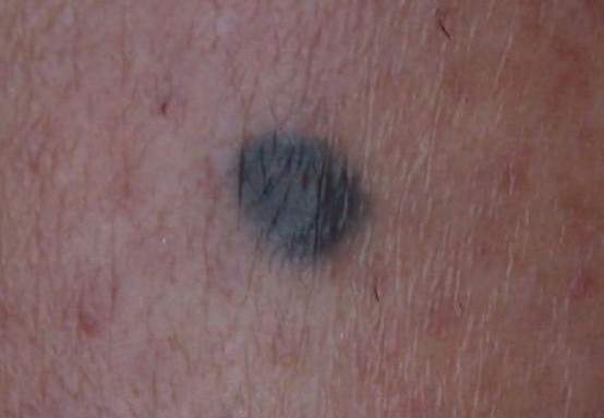 BLUE NEVUS