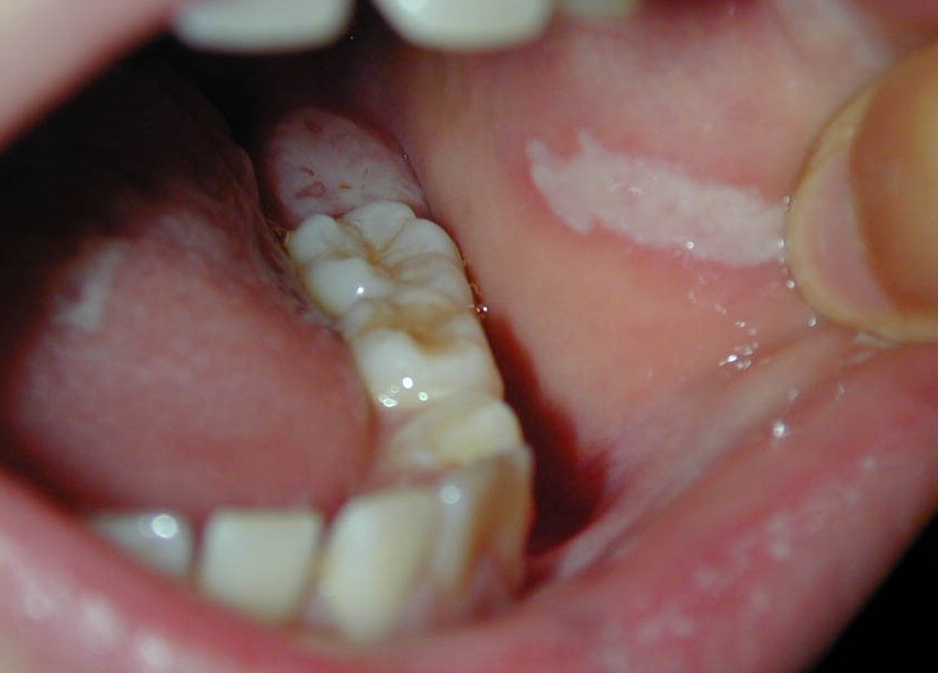 WHITE SPONGE NEVUS