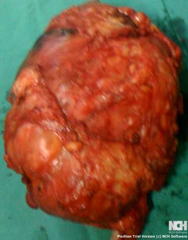 LIPOMA
