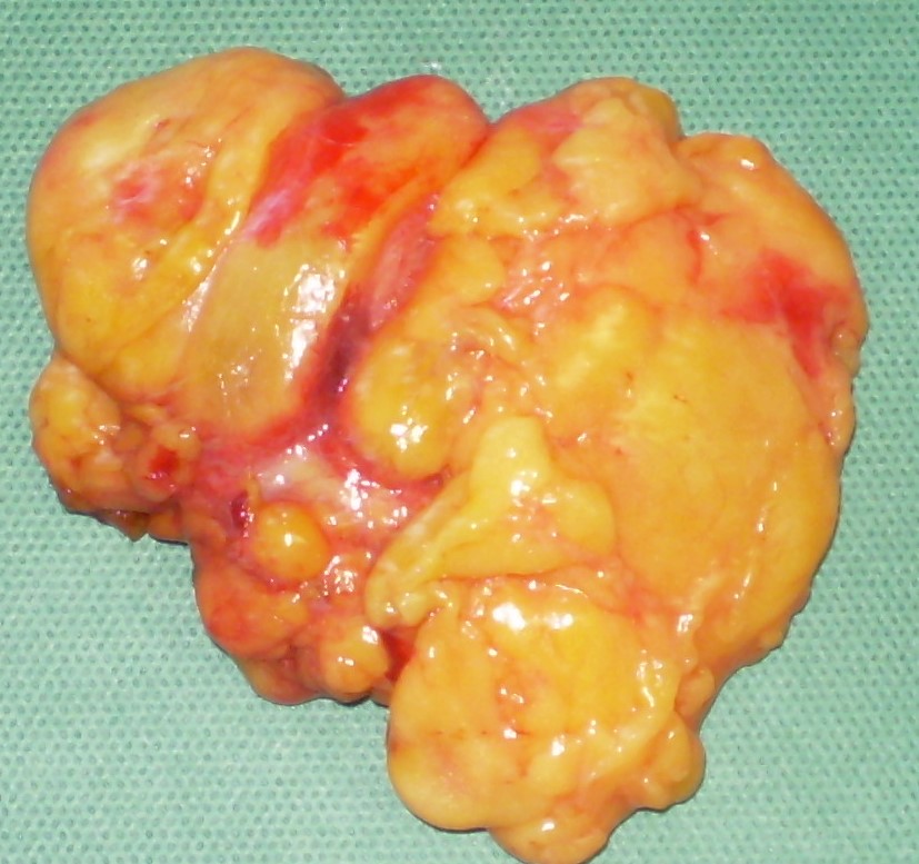LIPOMA