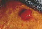 MALIGNANT FIBROUS HISTIOCYTOMA